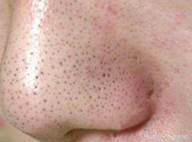全球最大粉刺黑头视频