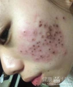 全球最大粉刺黑头视频